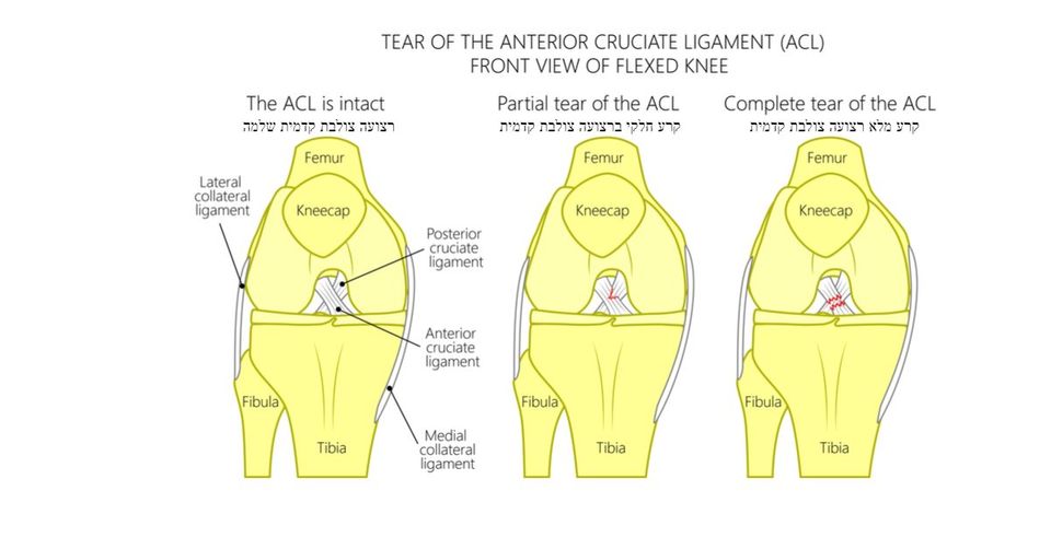 אתלטיקליניק | קרע ברצועה הצולבת בברך ACL. מתיחת רצועה בברך