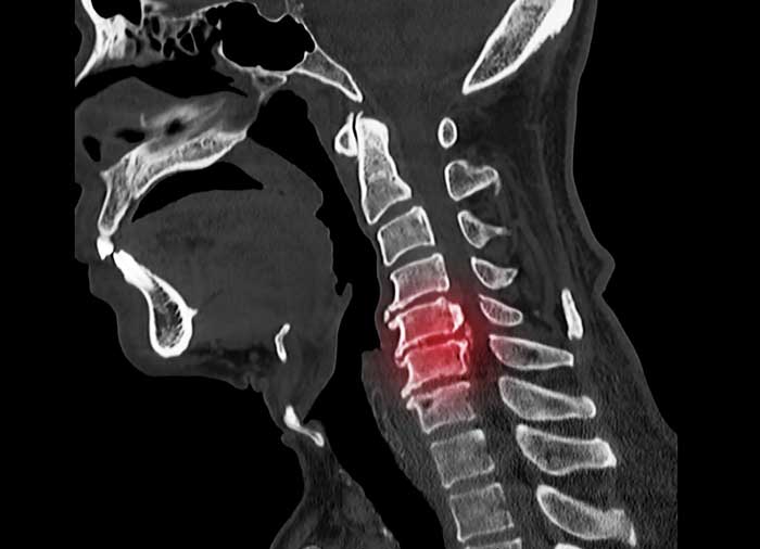 אתלטיקליניק, רפואת ספורט: מילופתיה צווארית. צוואר תפוס, כאב צוואר, כאבי צוואר