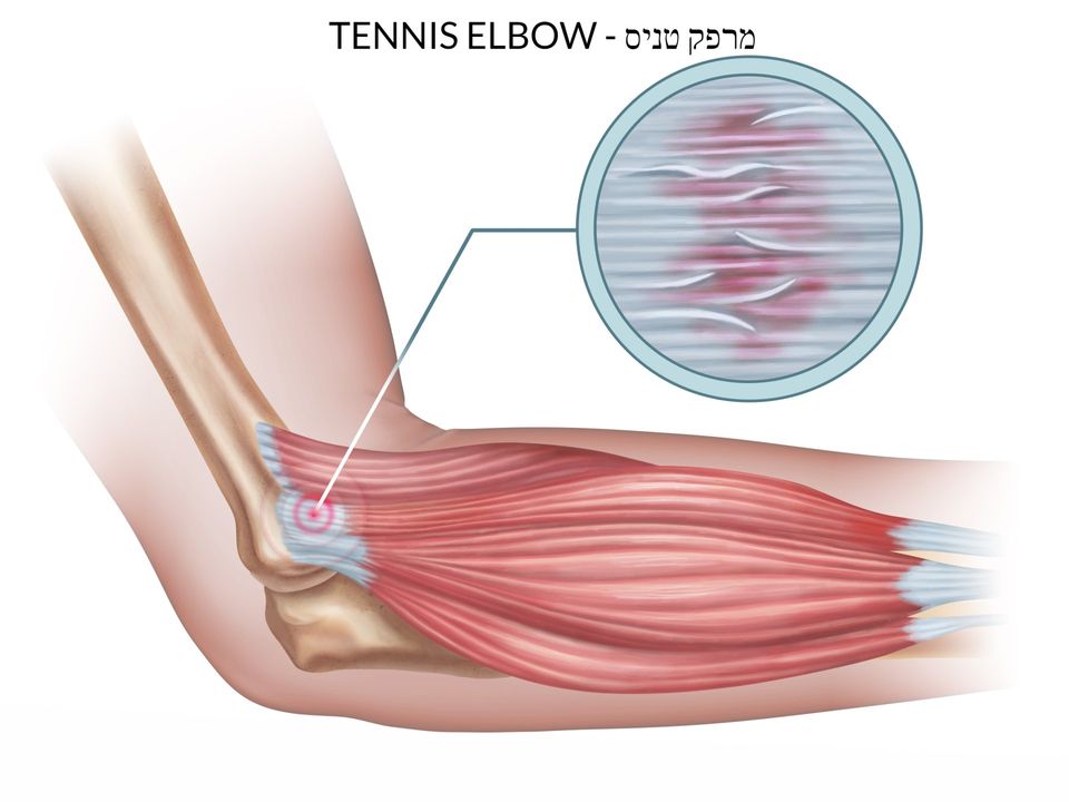 מרפק טניס - Tennis Elbow